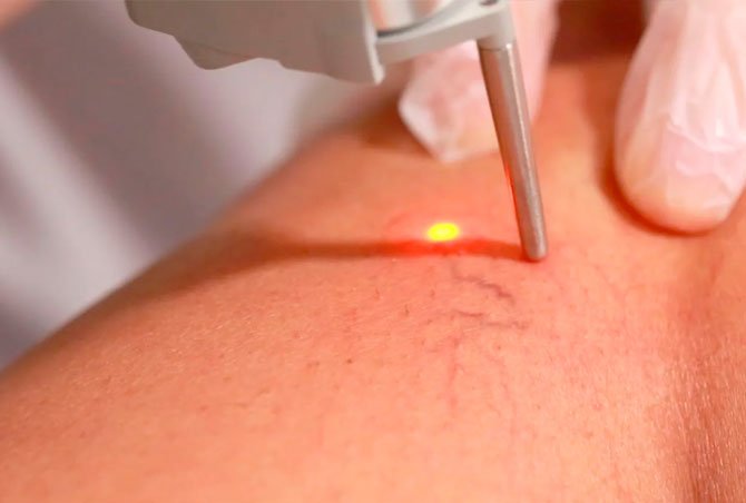 Tratamiento laser