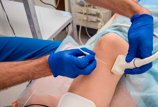 Ablacion quimica endovenosa